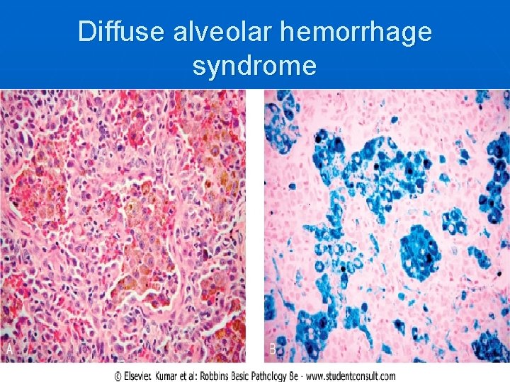 Diffuse alveolar hemorrhage syndrome 