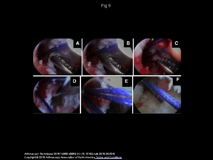 Fig 9 Arthroscopy Techniques 2018 7 e 989 -e 998 DOI: (10. 1016/j. eats.