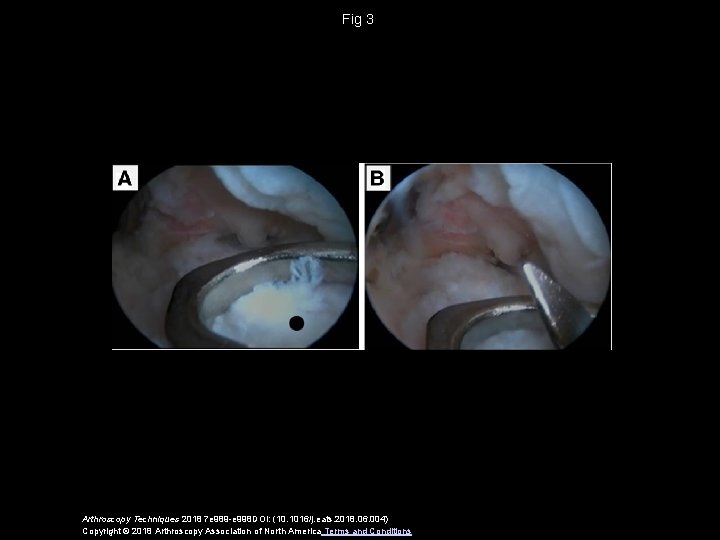 Fig 3 Arthroscopy Techniques 2018 7 e 989 -e 998 DOI: (10. 1016/j. eats.