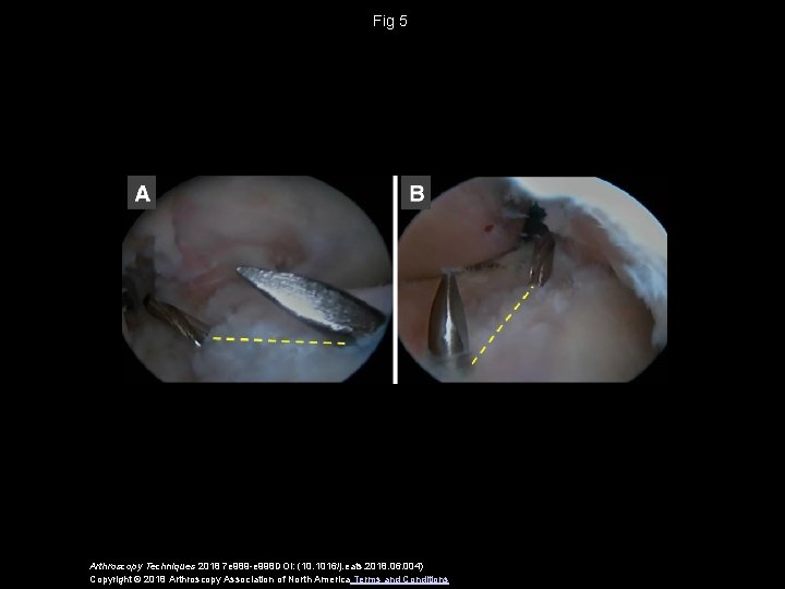 Fig 5 Arthroscopy Techniques 2018 7 e 989 -e 998 DOI: (10. 1016/j. eats.