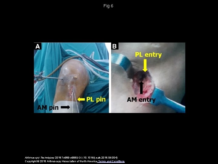 Fig 6 Arthroscopy Techniques 2018 7 e 989 -e 998 DOI: (10. 1016/j. eats.