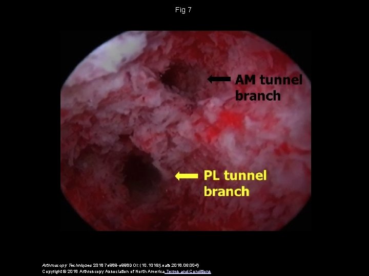 Fig 7 Arthroscopy Techniques 2018 7 e 989 -e 998 DOI: (10. 1016/j. eats.