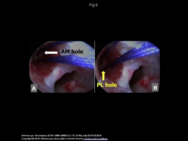 Fig 8 Arthroscopy Techniques 2018 7 e 989 -e 998 DOI: (10. 1016/j. eats.