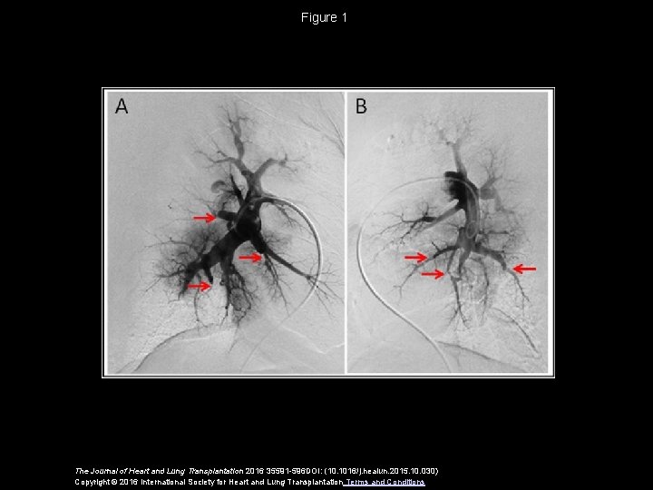 Figure 1 The Journal of Heart and Lung Transplantation 2016 35591 -596 DOI: (10.