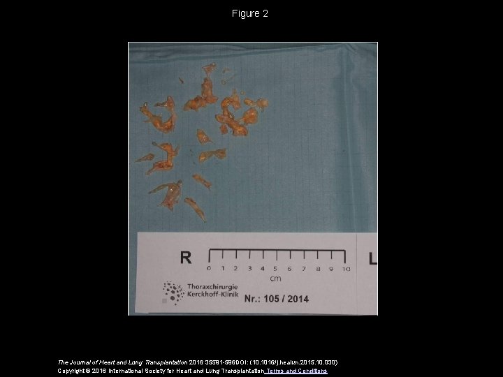 Figure 2 The Journal of Heart and Lung Transplantation 2016 35591 -596 DOI: (10.