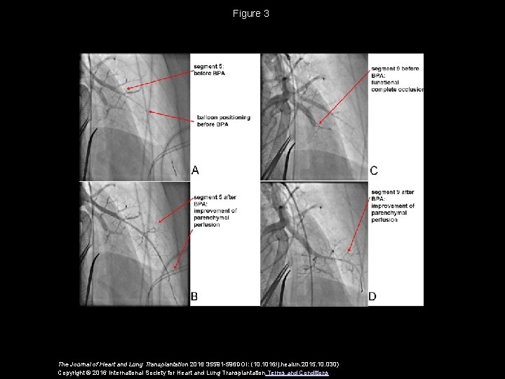 Figure 3 The Journal of Heart and Lung Transplantation 2016 35591 -596 DOI: (10.