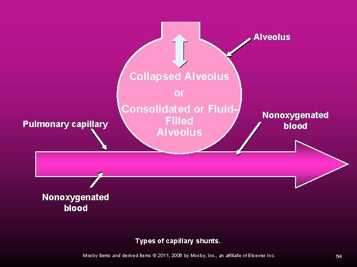 Alveolus Pulmonary capillary Collapsed Alveolus or Consolidated or Fluid. Filled Alveolus Nonoxygenated blood Types