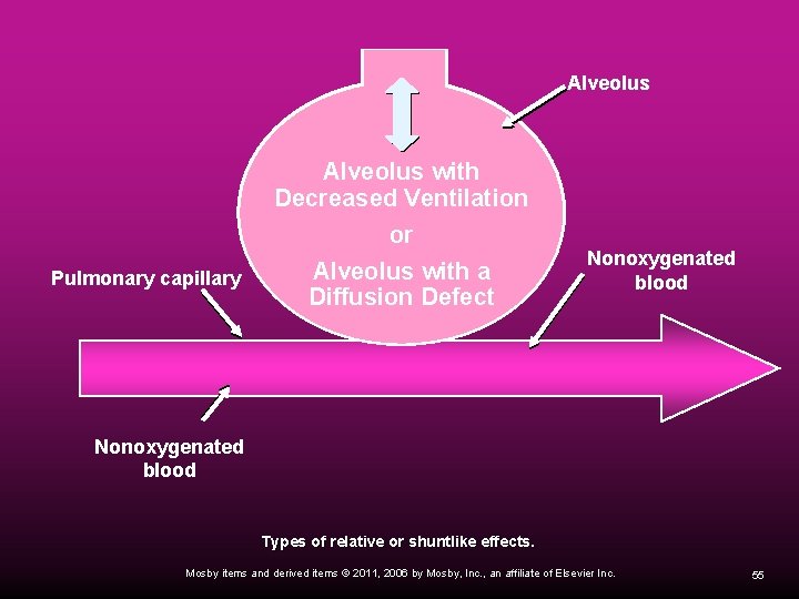 Alveolus Pulmonary capillary Alveolus with Decreased Ventilation or Alveolus with a Diffusion Defect Nonoxygenated