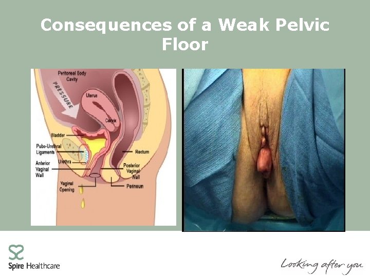 Consequences of a Weak Pelvic Floor 