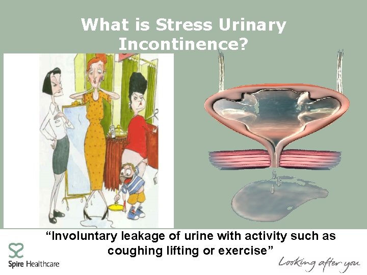 What is Stress Urinary Incontinence? “Involuntary leakage of urine with activity such as coughing