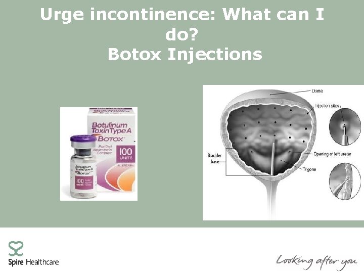 Urge incontinence: What can I do? Botox Injections 