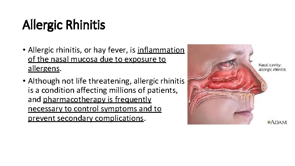 Allergic Rhinitis • Allergic rhinitis, or hay fever, is inflammation of the nasal mucosa