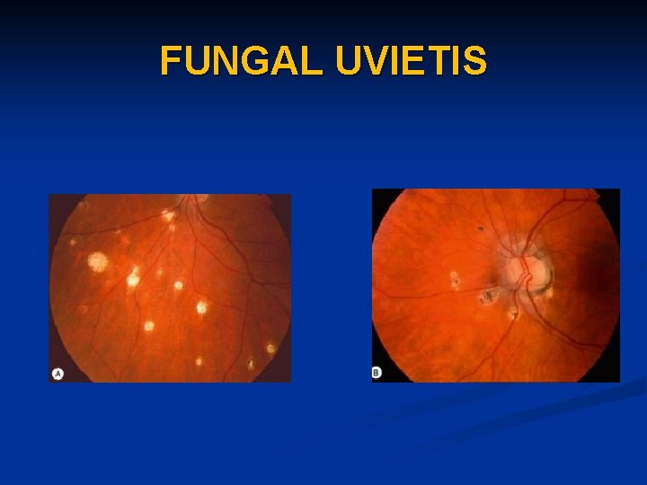 FUNGAL UVIETIS 