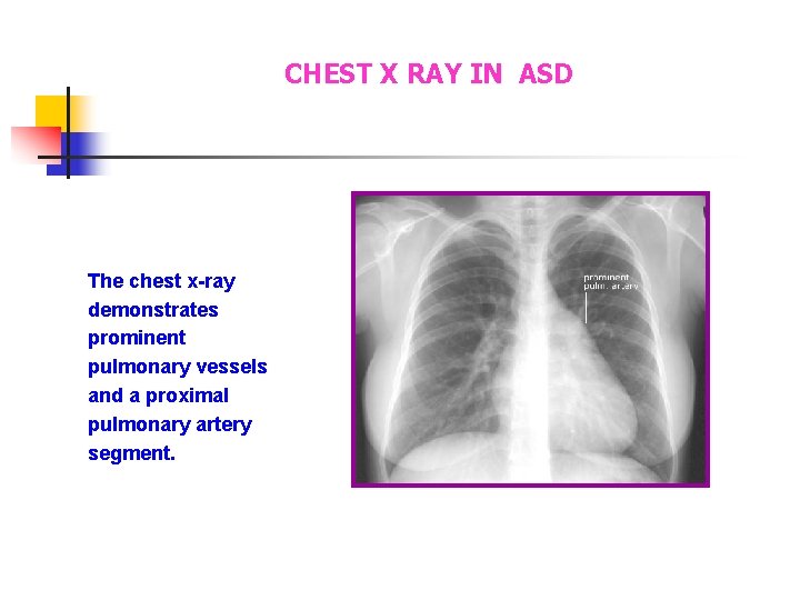 CHEST X RAY IN ASD The chest x-ray demonstrates prominent pulmonary vessels and a CHEST X RAY IN ASD The chest x-ray demonstrates prominent pulmonary vessels and a
