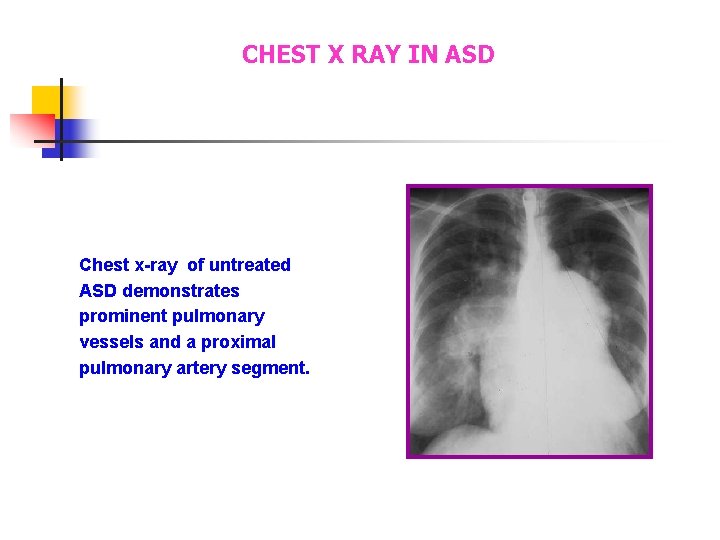 CHEST X RAY IN ASD Chest x-ray of untreated ASD demonstrates prominent pulmonary vessels CHEST X RAY IN ASD Chest x-ray of untreated ASD demonstrates prominent pulmonary vessels