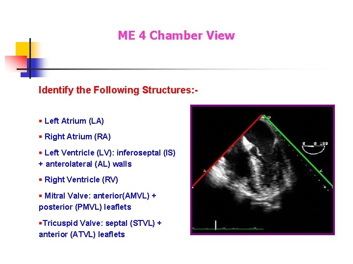 ME 4 Chamber View Identify the Following Structures: § Left Atrium (LA) § Right ME 4 Chamber View Identify the Following Structures: § Left Atrium (LA) § Right