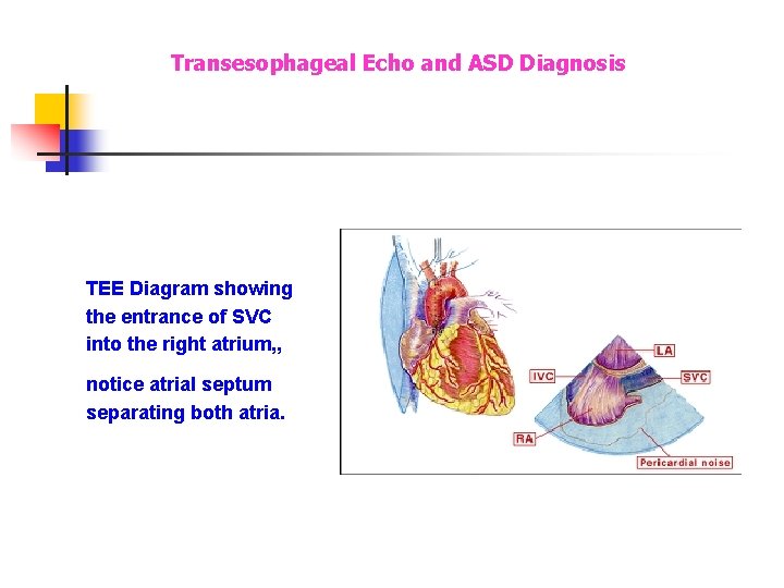 Transesophageal Echo and ASD Diagnosis TEE Diagram showing the entrance of SVC into the Transesophageal Echo and ASD Diagnosis TEE Diagram showing the entrance of SVC into the