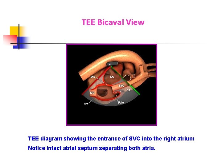 TEE Bicaval View TEE diagram showing the entrance of SVC into the right atrium TEE Bicaval View TEE diagram showing the entrance of SVC into the right atrium