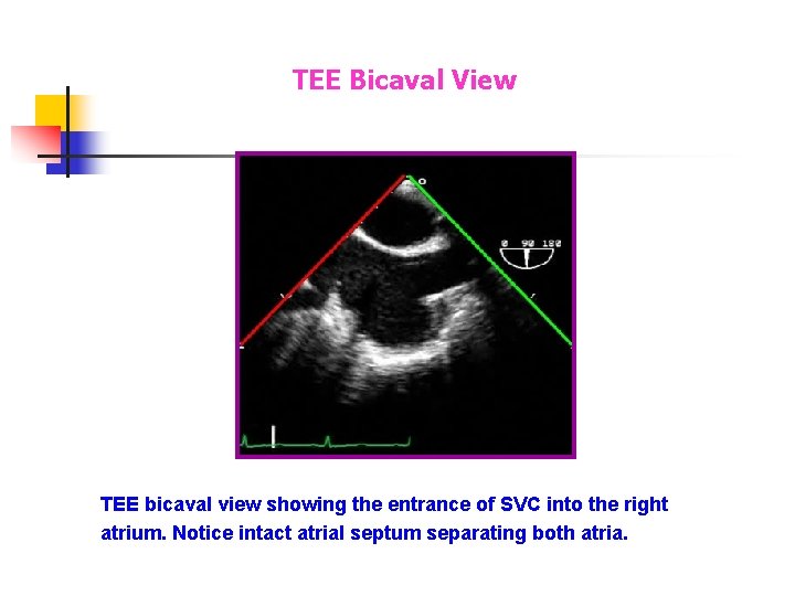 TEE Bicaval View TEE bicaval view showing the entrance of SVC into the right TEE Bicaval View TEE bicaval view showing the entrance of SVC into the right