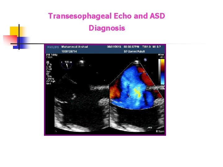Transesophageal Echo and ASD Diagnosis Transesophageal Echo and ASD Diagnosis