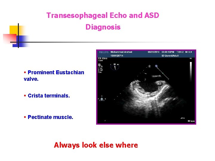 Transesophageal Echo and ASD Diagnosis § Prominent Eustachian valve. § Crista terminals. § Pectinate Transesophageal Echo and ASD Diagnosis § Prominent Eustachian valve. § Crista terminals. § Pectinate
