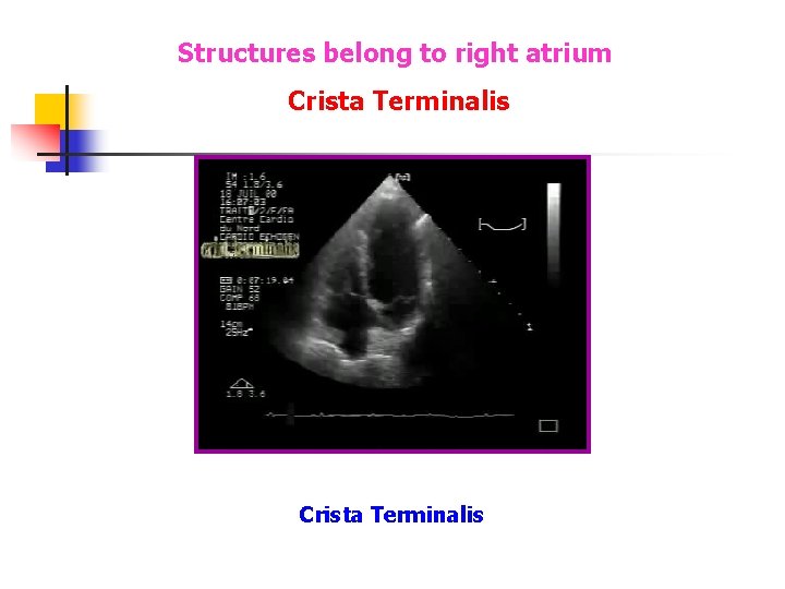 Structures belong to right atrium Crista Terminalis Structures belong to right atrium Crista Terminalis