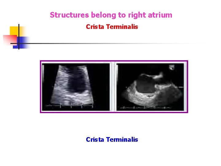 Structures belong to right atrium Crista Terminalis Structures belong to right atrium Crista Terminalis