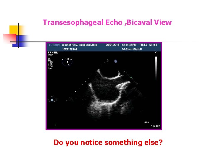 Transesophageal Echo , Bicaval View Do you notice something else? Transesophageal Echo , Bicaval View Do you notice something else?