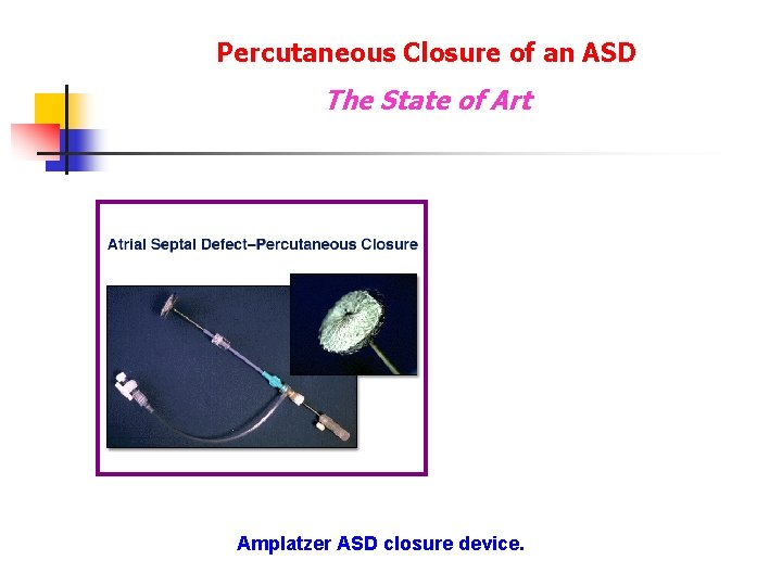 Percutaneous Closure of an ASD The State of Art Amplatzer ASD closure device. Percutaneous Closure of an ASD The State of Art Amplatzer ASD closure device.