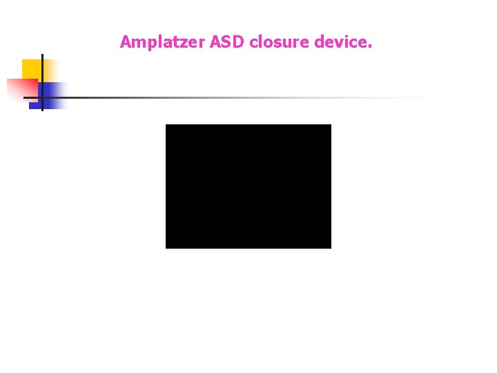 Amplatzer ASD closure device. Amplatzer ASD closure device.