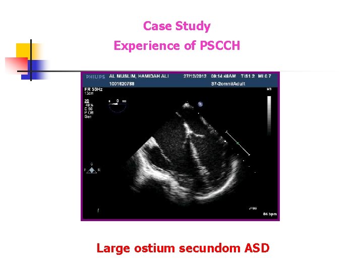 Case Study Experience of PSCCH Large ostium secundom ASD Case Study Experience of PSCCH Large ostium secundom ASD