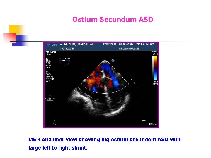 Ostium Secundum ASD ME 4 chamber view showing big ostium secundom ASD with large Ostium Secundum ASD ME 4 chamber view showing big ostium secundom ASD with large