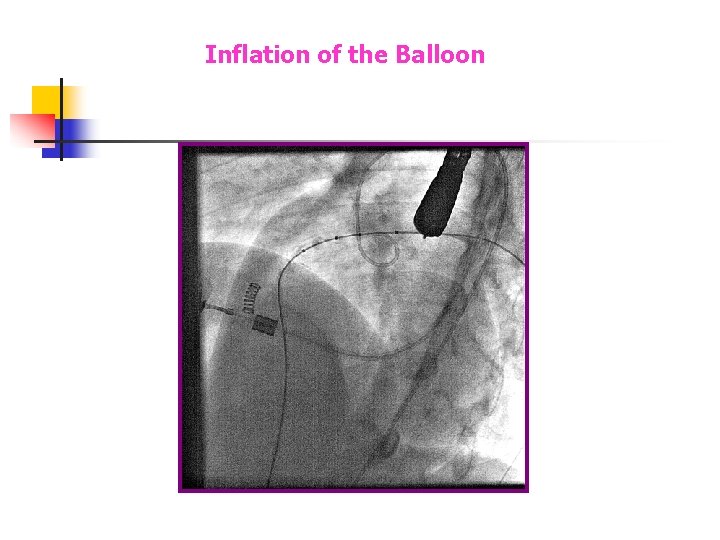 Inflation of the Balloon Inflation of the Balloon