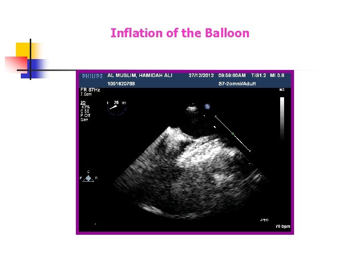 Inflation of the Balloon Inflation of the Balloon