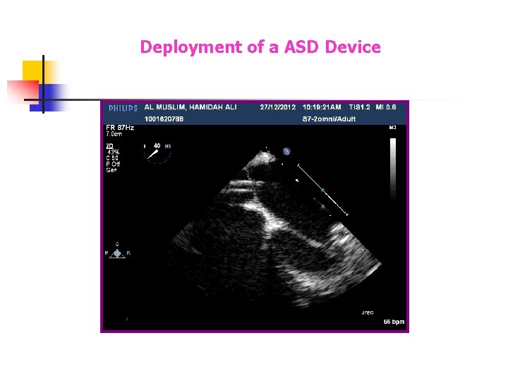 Deployment of a ASD Device Deployment of a ASD Device