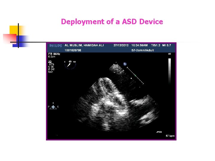 Deployment of a ASD Device Deployment of a ASD Device