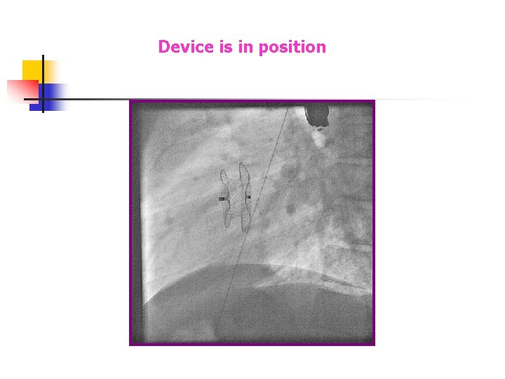 Device is in position Device is in position