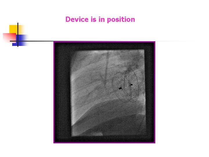 Device is in position Device is in position