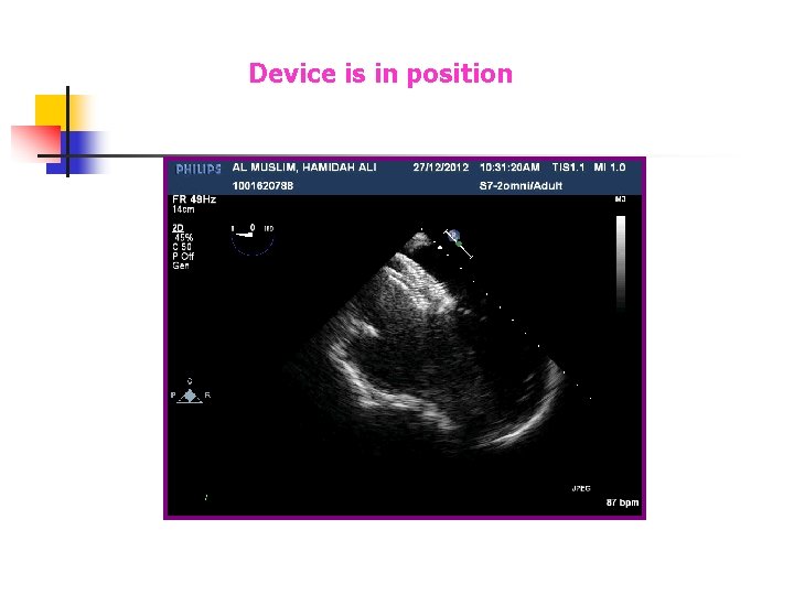 Device is in position Device is in position