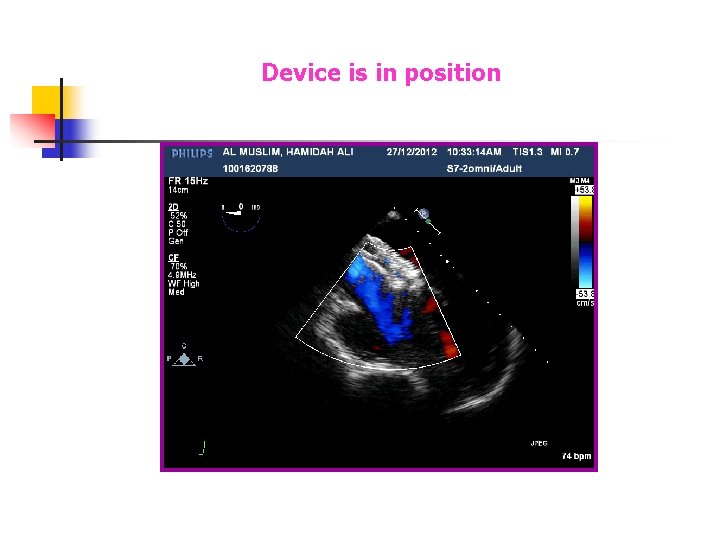 Device is in position Device is in position