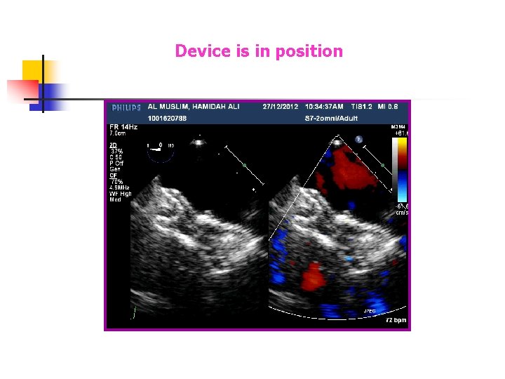 Device is in position Device is in position