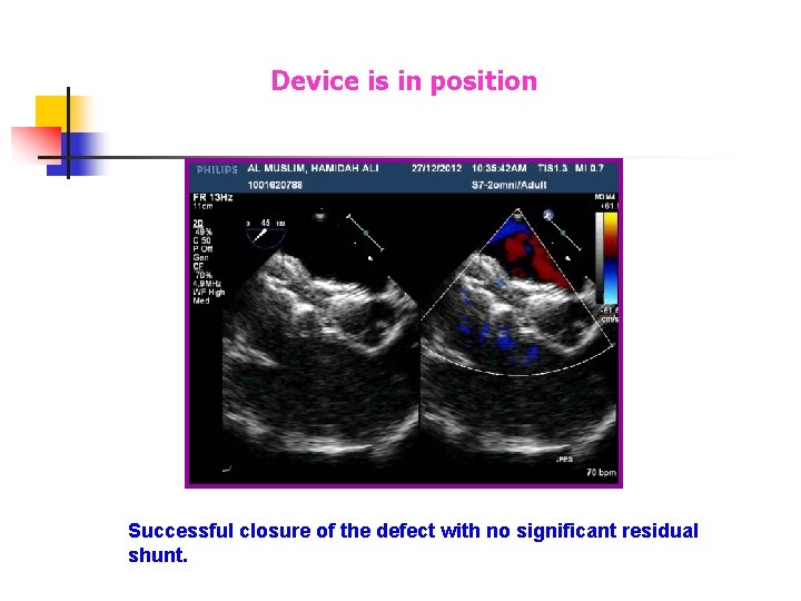 Device is in position Successful closure of the defect with no significant residual shunt. Device is in position Successful closure of the defect with no significant residual shunt.