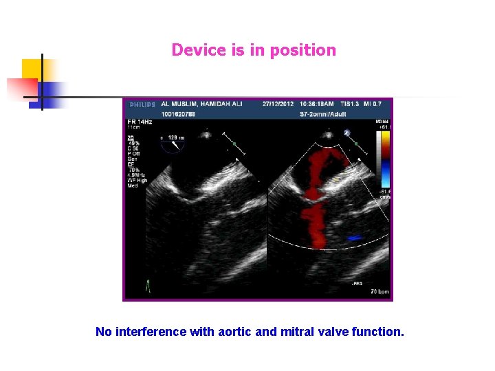 Device is in position No interference with aortic and mitral valve function. Device is in position No interference with aortic and mitral valve function.