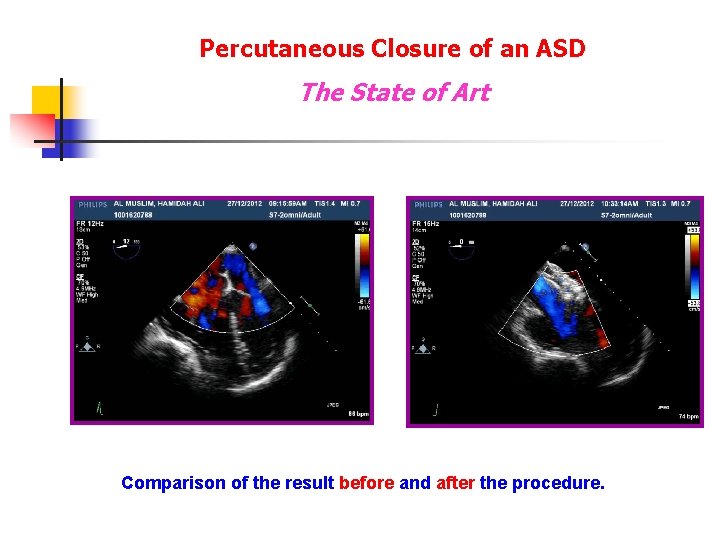 Percutaneous Closure of an ASD The State of Art Comparison of the result before Percutaneous Closure of an ASD The State of Art Comparison of the result before