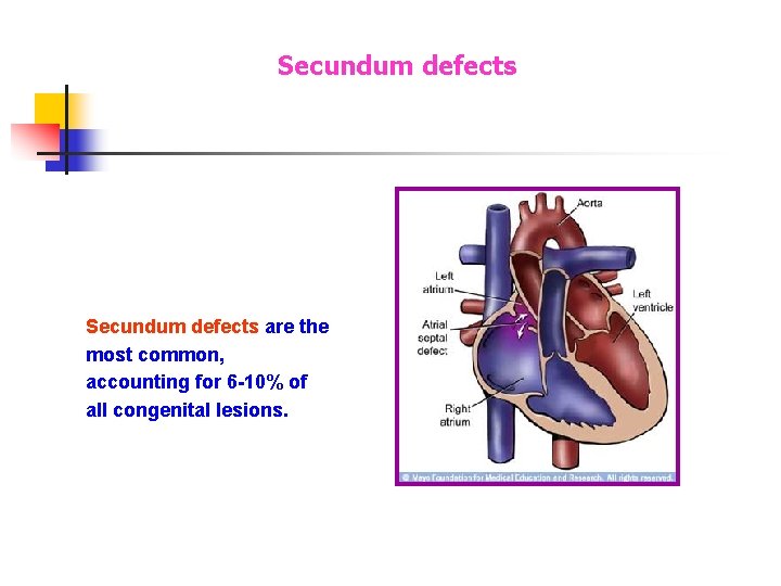 Secundum defects are the most common, accounting for 6 -10% of all congenital lesions. Secundum defects are the most common, accounting for 6 -10% of all congenital lesions.
