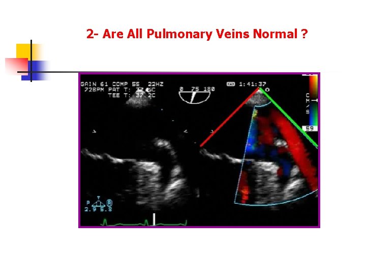 2 - Are All Pulmonary Veins Normal ? 2 - Are All Pulmonary Veins Normal ?