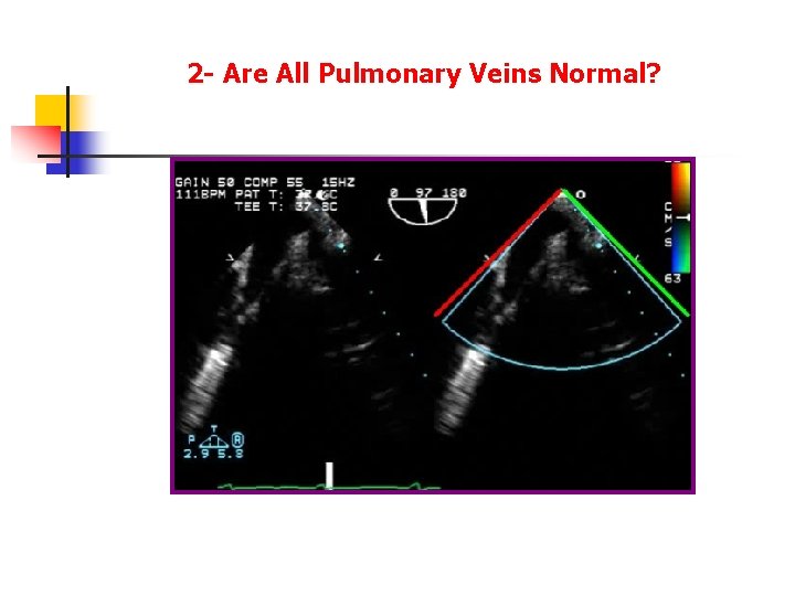 2 - Are All Pulmonary Veins Normal? 2 - Are All Pulmonary Veins Normal?