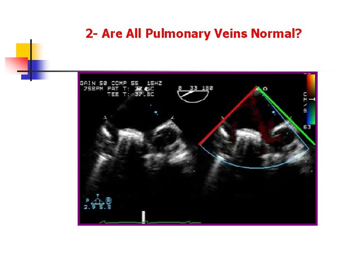 2 - Are All Pulmonary Veins Normal? 2 - Are All Pulmonary Veins Normal?