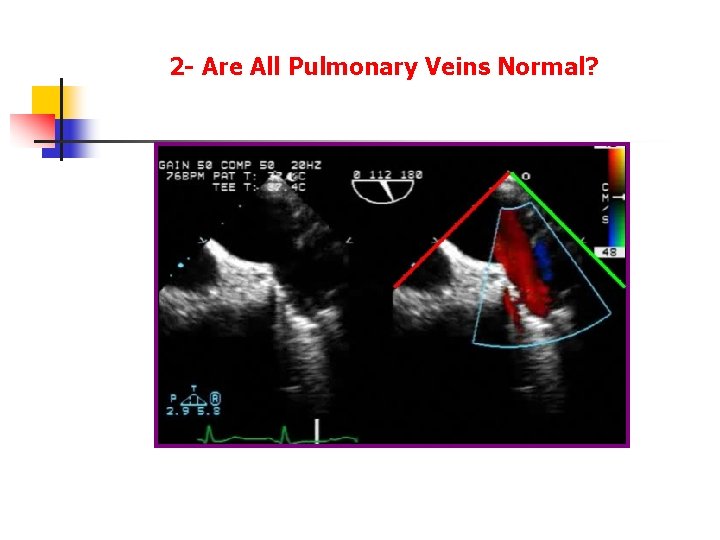 2 - Are All Pulmonary Veins Normal? 2 - Are All Pulmonary Veins Normal?