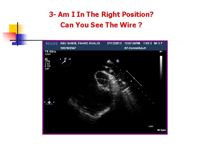 3 - Am I In The Right Position? Can You See The Wire ? 3 - Am I In The Right Position? Can You See The Wire ?